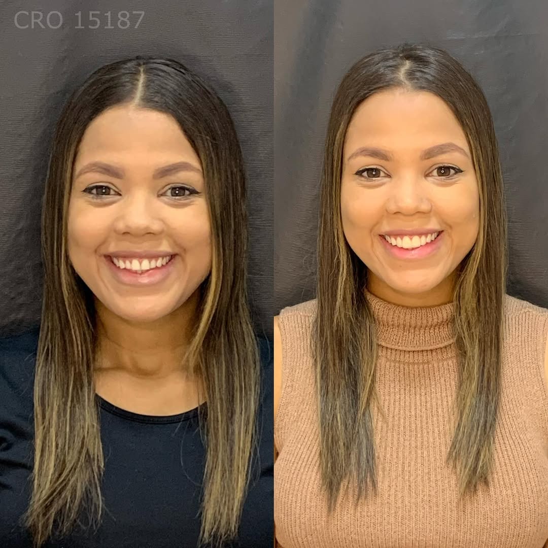 Transformação de Sorriso 8